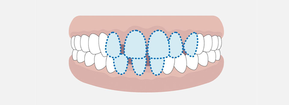 月島いなば歯科のすきっ歯ページ