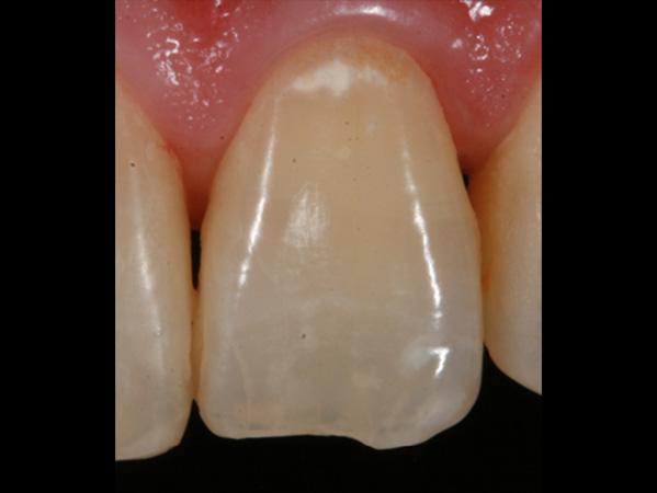 ホワイトスポット症例