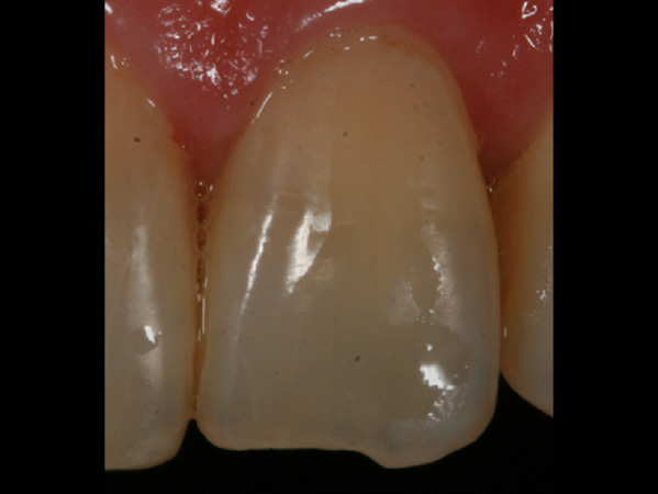 ホワイトスポット症例